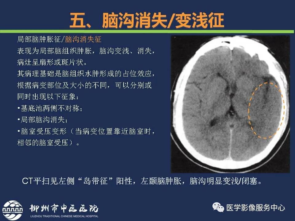 【PPT】超早期脑梗死CT征象-53