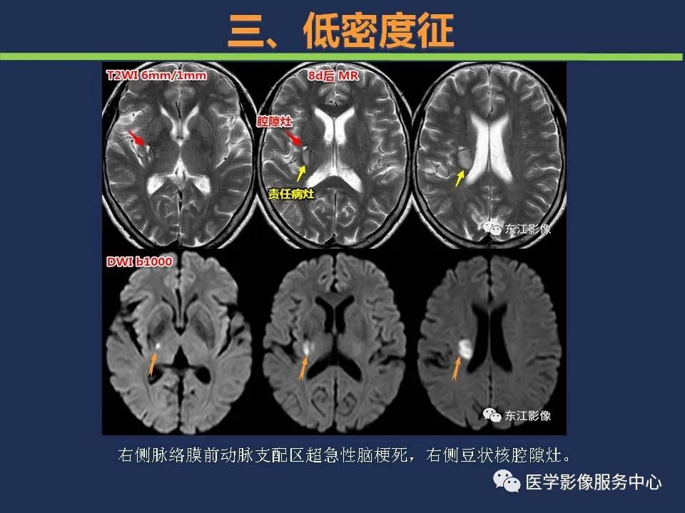 【PPT】超早期脑梗死CT征象-46