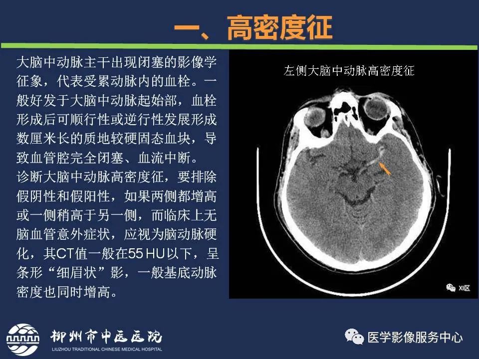 【PPT】超早期脑梗死CT征象-6