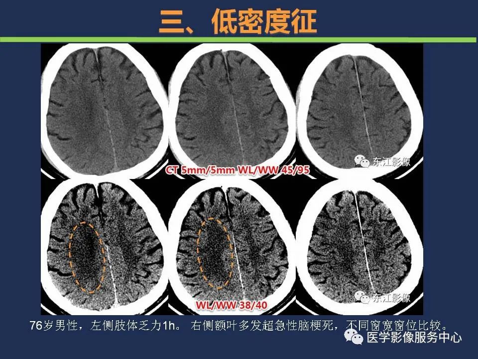 【PPT】超早期脑梗死CT征象-43