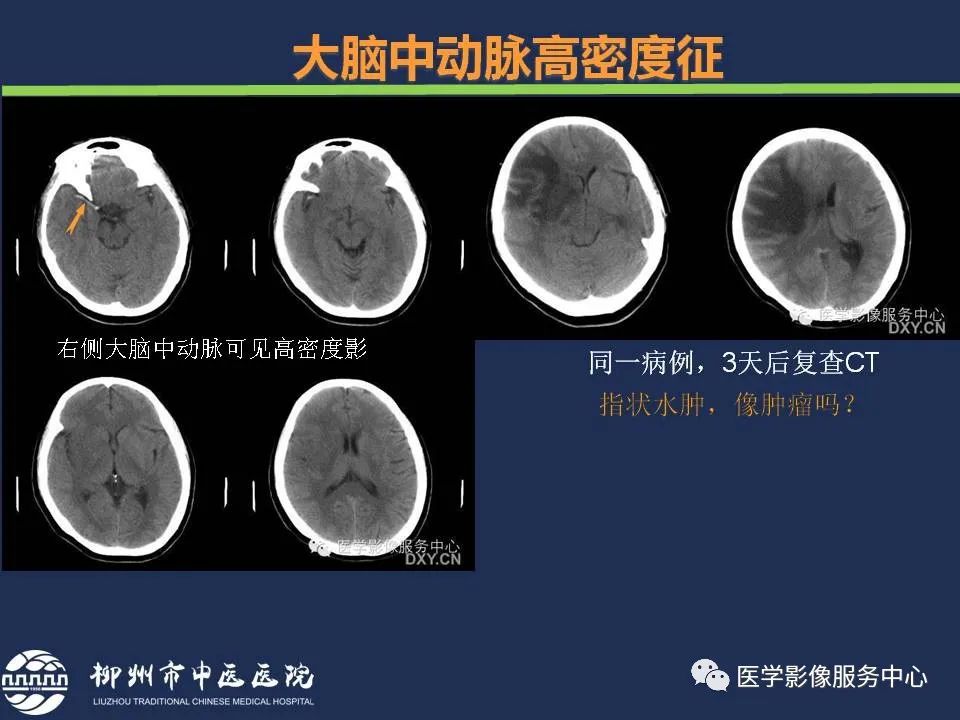 【PPT】超早期脑梗死CT征象-14