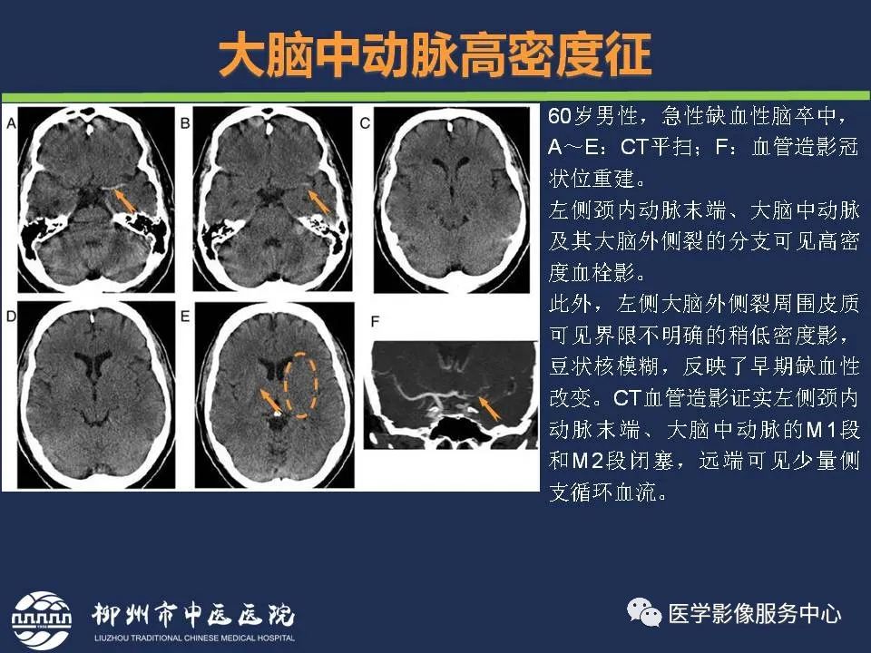 【PPT】超早期脑梗死CT征象-17