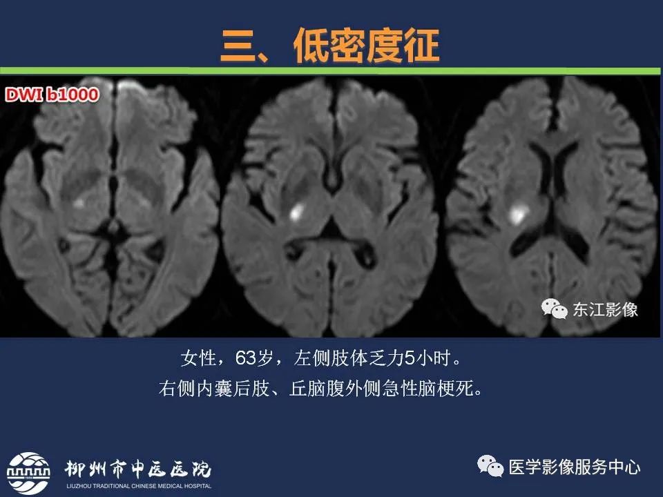 【PPT】超早期脑梗死CT征象-39