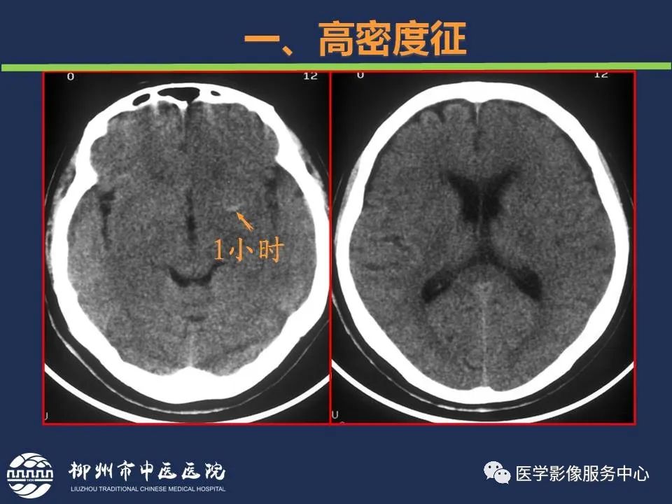 【PPT】超早期脑梗死CT征象-8