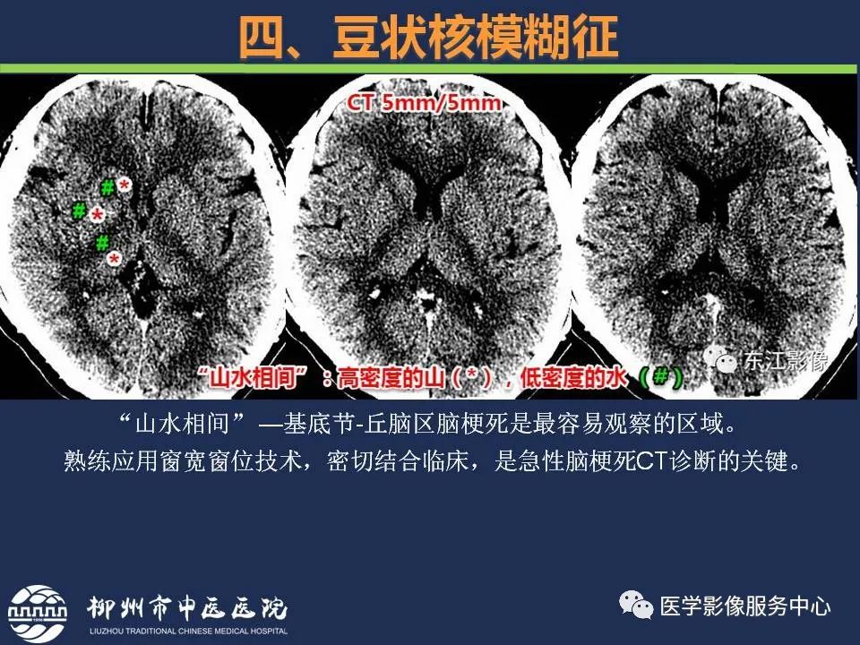 【PPT】超早期脑梗死CT征象-51