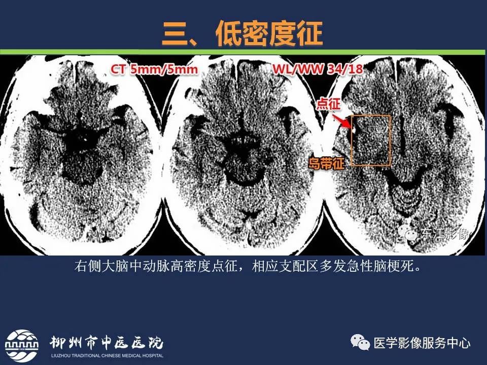 【PPT】超早期脑梗死CT征象-37