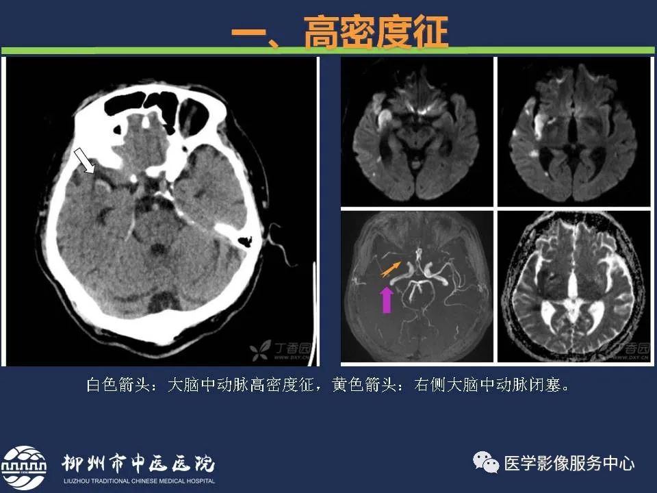 【PPT】超早期脑梗死CT征象-10