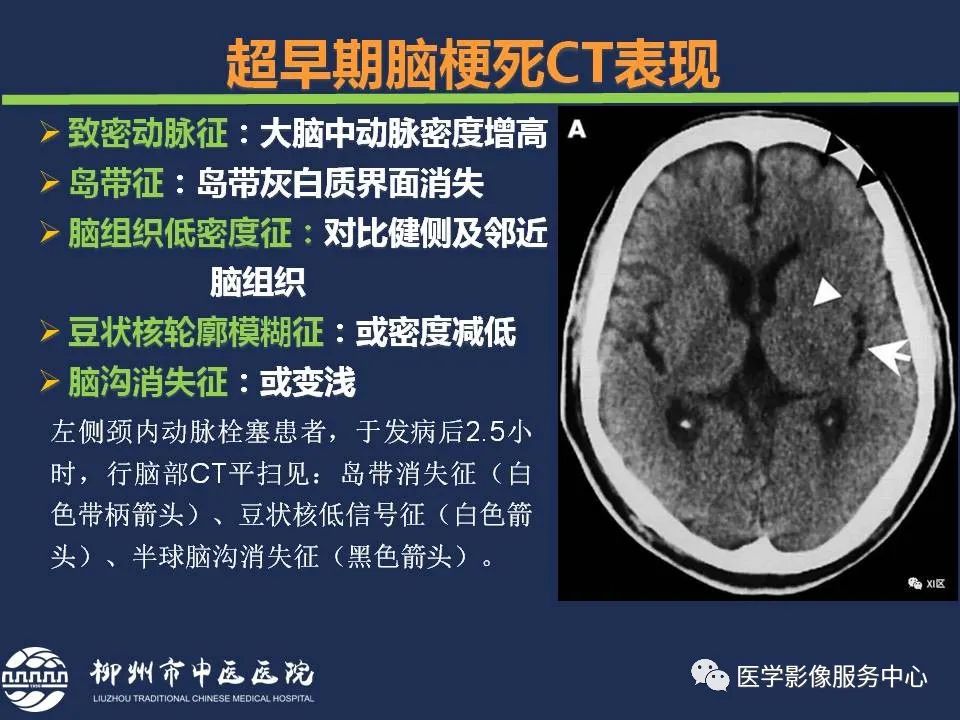 【PPT】超早期脑梗死CT征象-5