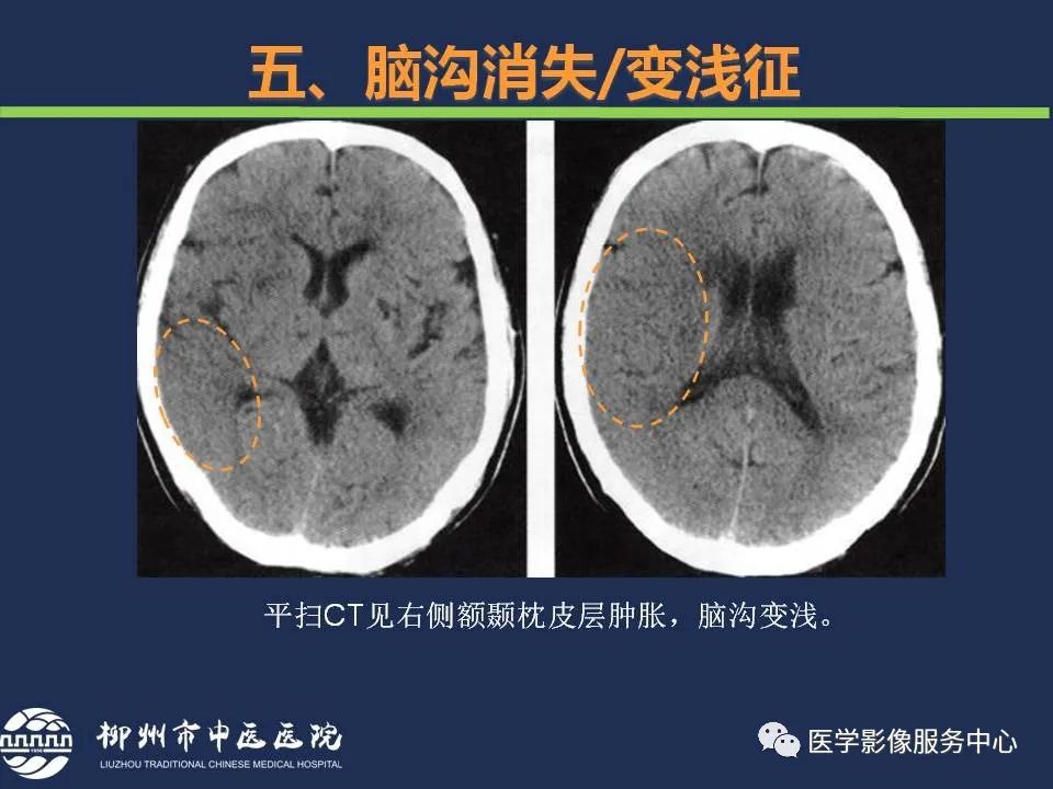 【PPT】超早期脑梗死CT征象-54