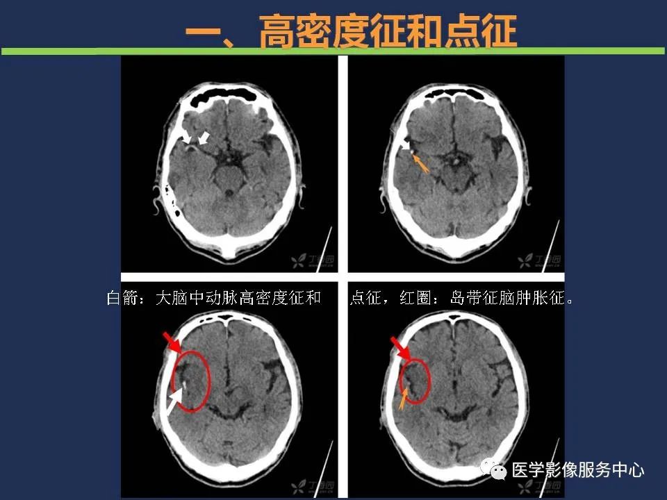 【PPT】超早期脑梗死CT征象-11