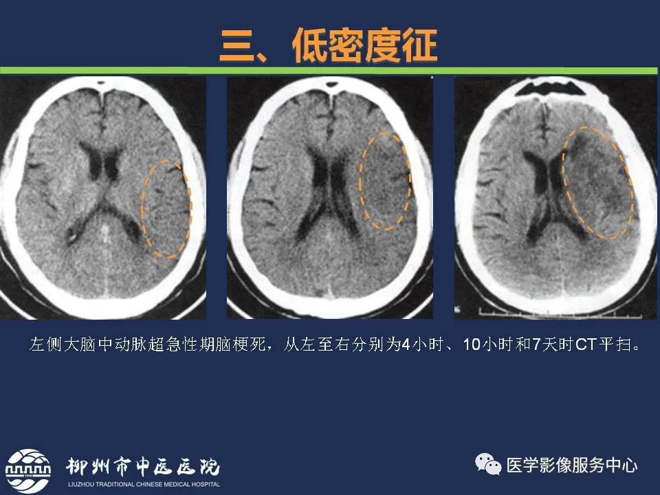 【PPT】超早期脑梗死CT征象-30