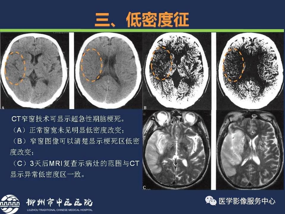 【PPT】超早期脑梗死CT征象-31