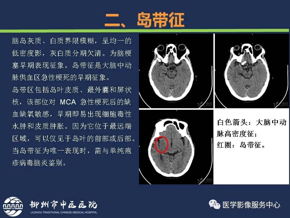 【PPT】超早期脑梗死CT征象-28