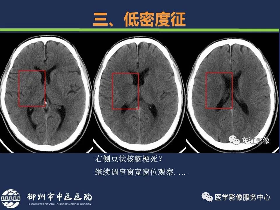 【PPT】超早期脑梗死CT征象-34