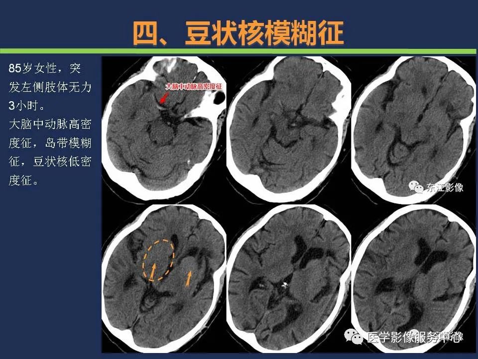【PPT】超早期脑梗死CT征象-49