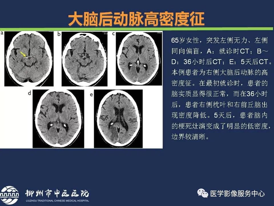 【PPT】超早期脑梗死CT征象-25