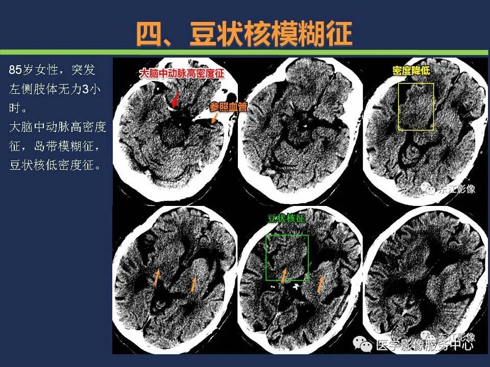 【PPT】超早期脑梗死CT征象-50