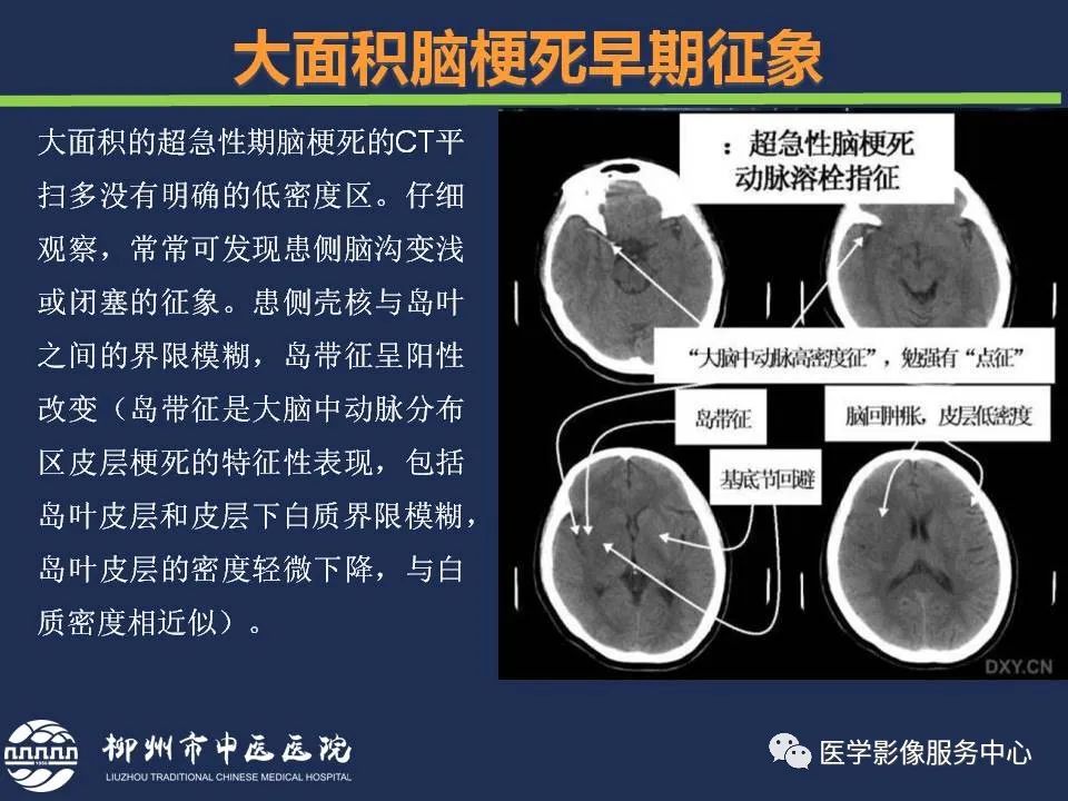 【PPT】超早期脑梗死CT征象-19