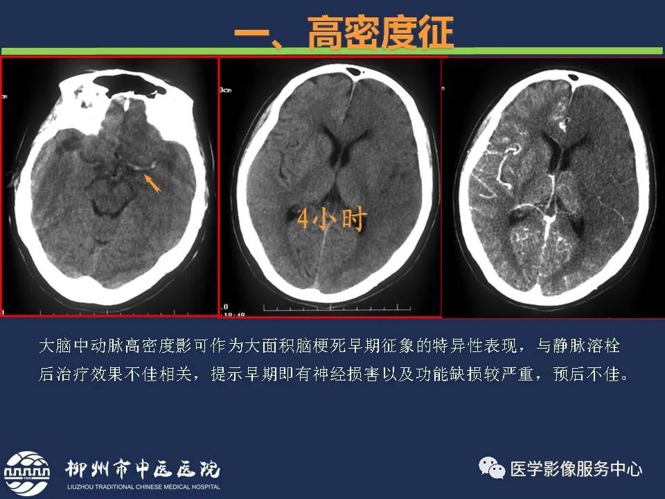 【PPT】超早期脑梗死CT征象-9