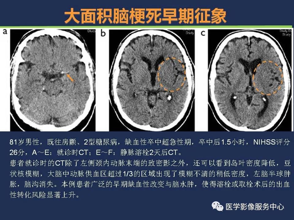 【PPT】超早期脑梗死CT征象-20