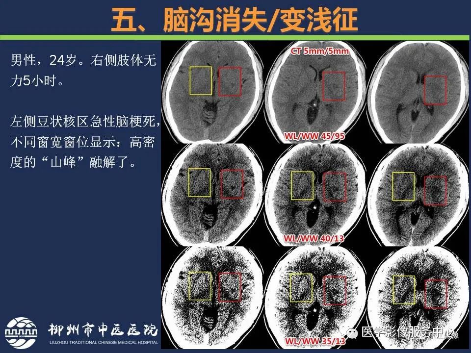 【PPT】超早期脑梗死CT征象-52