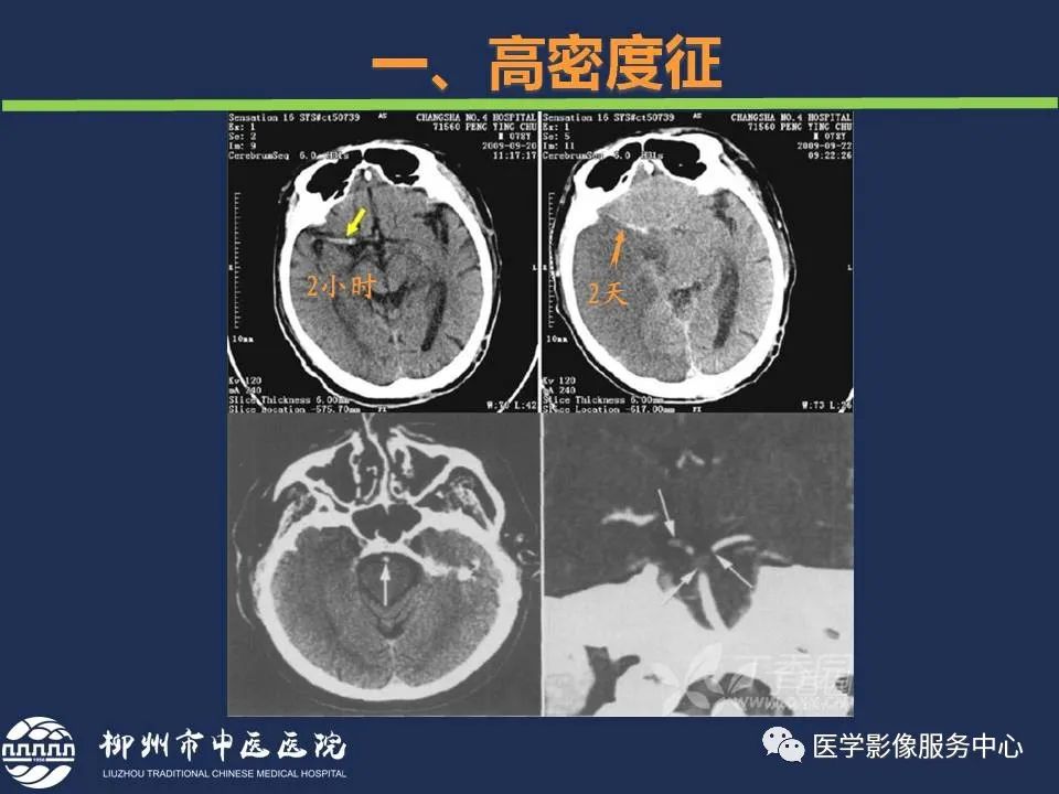 【PPT】超早期脑梗死CT征象-7