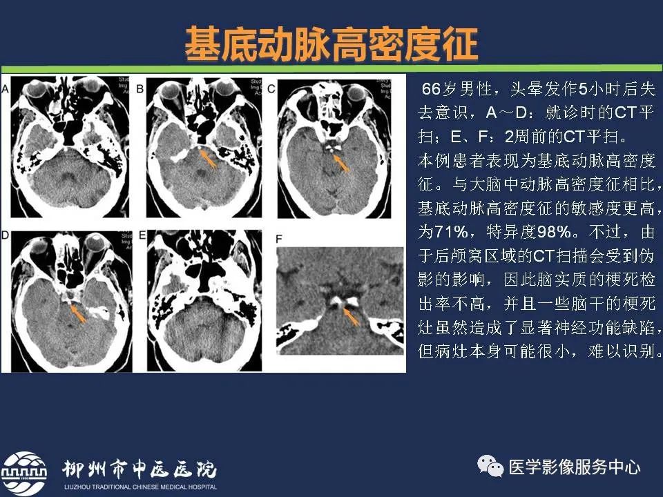 【PPT】超早期脑梗死CT征象-23