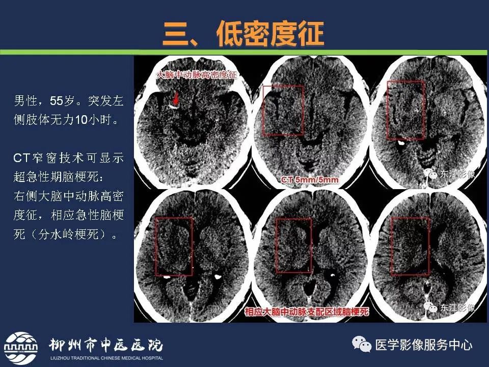 【PPT】超早期脑梗死CT征象-32