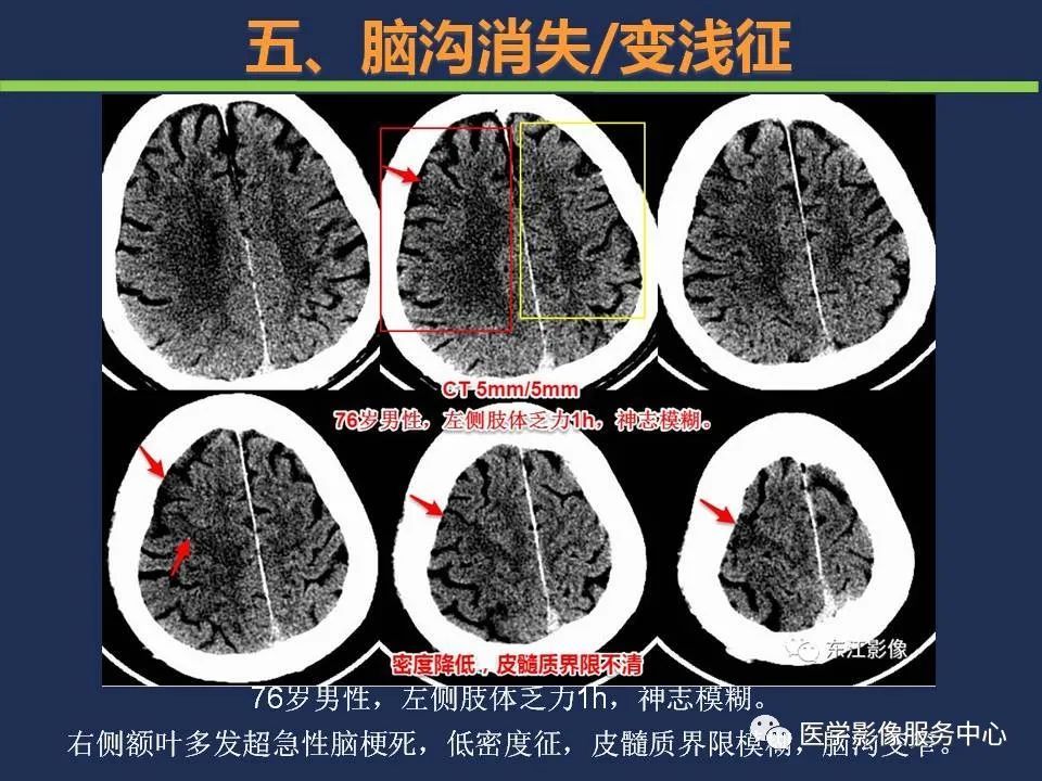 【PPT】超早期脑梗死CT征象-55
