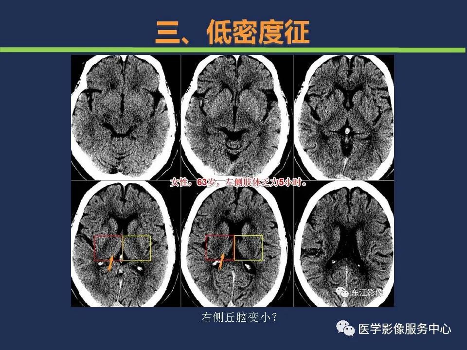 【PPT】超早期脑梗死CT征象-38