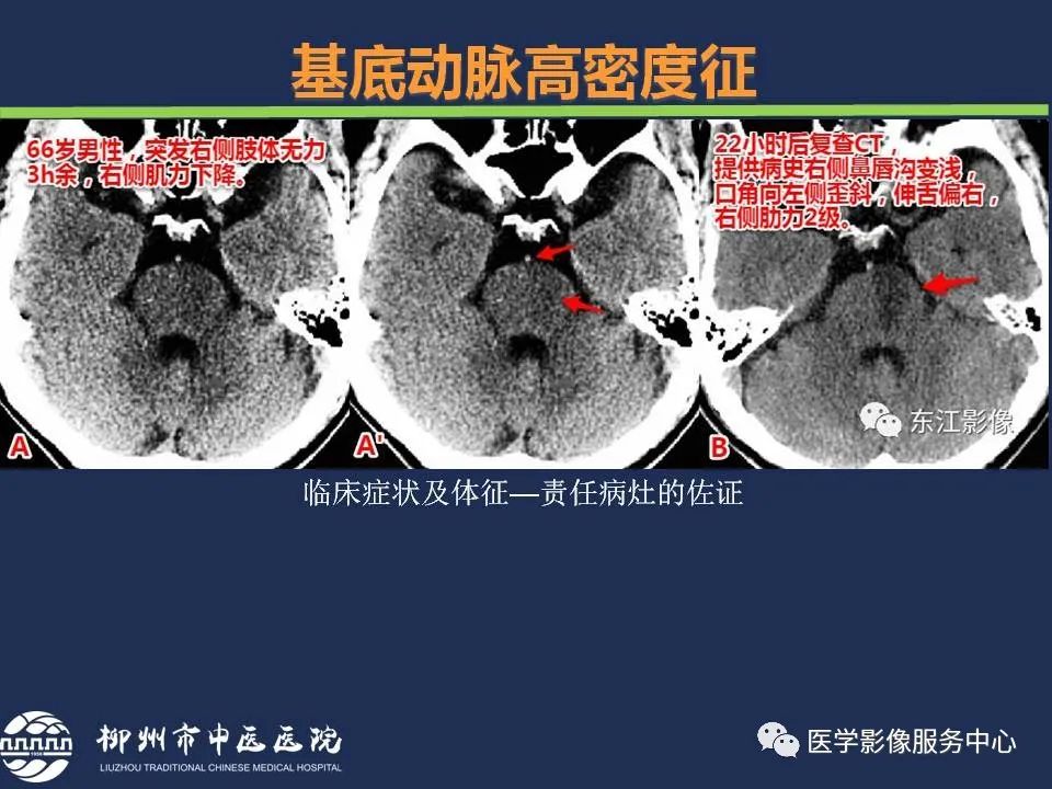 【PPT】超早期脑梗死CT征象-24
