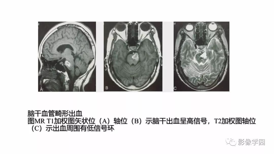 【PPT】脑干病变的影像学表现-17