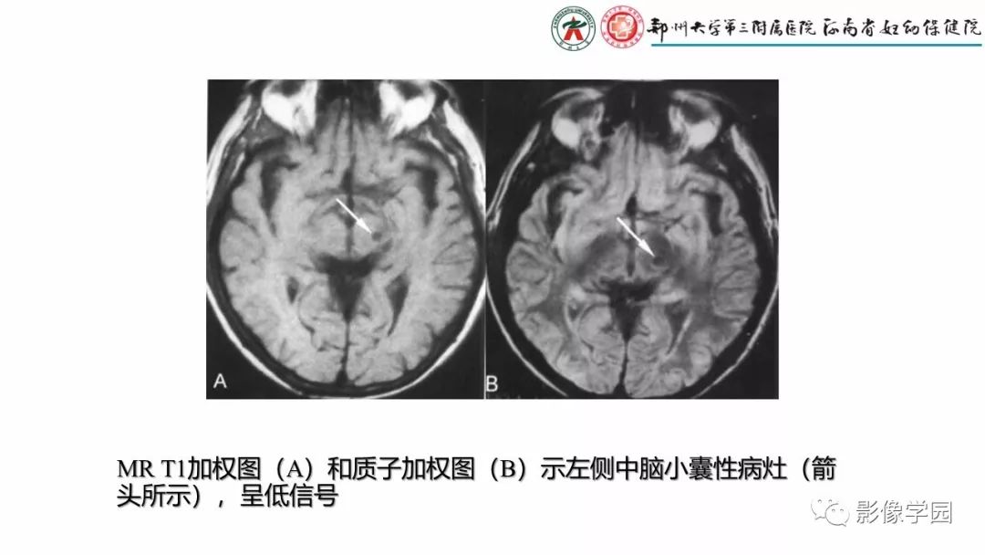 【PPT】脑干病变的影像学表现-22