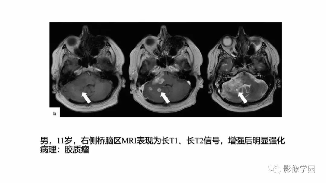 【PPT】脑干病变的影像学表现-7