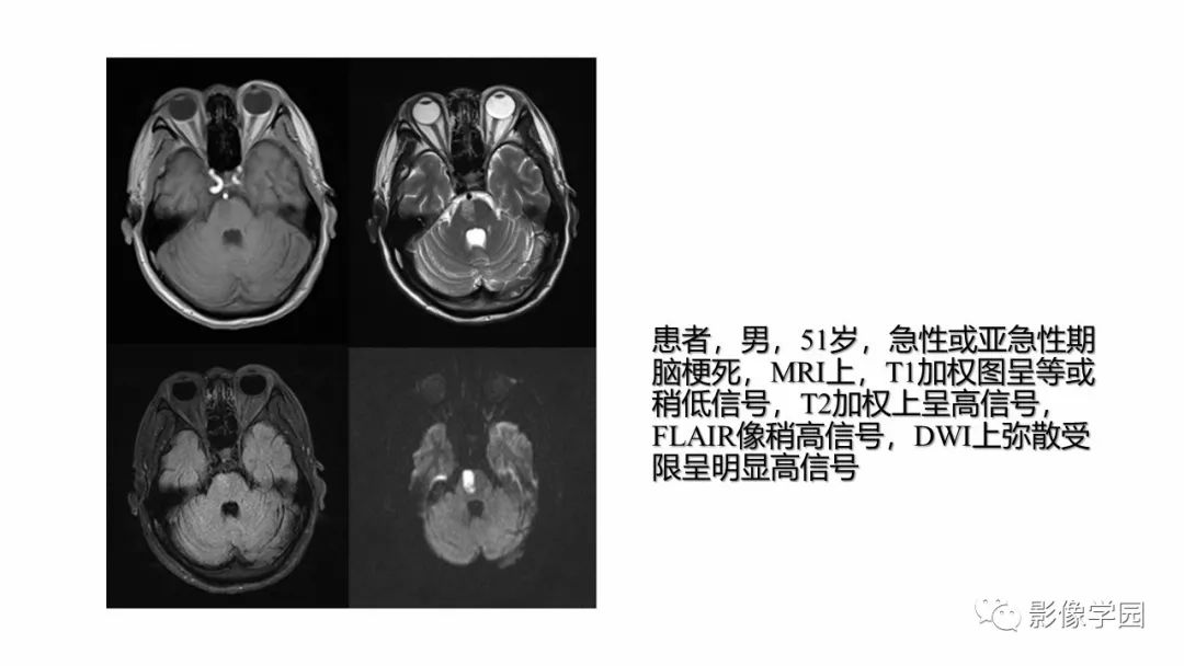 【PPT】脑干病变的影像学表现-14