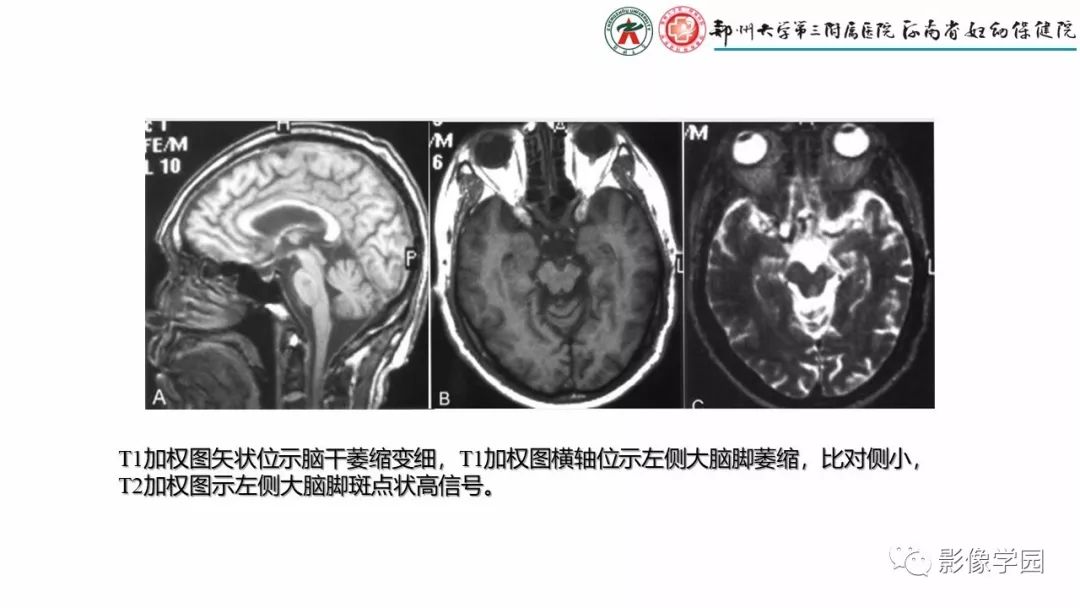 【PPT】脑干病变的影像学表现-34