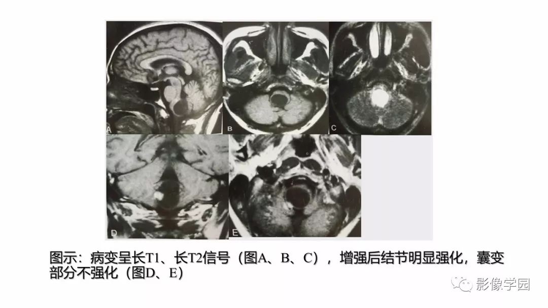 【PPT】脑干病变的影像学表现-10