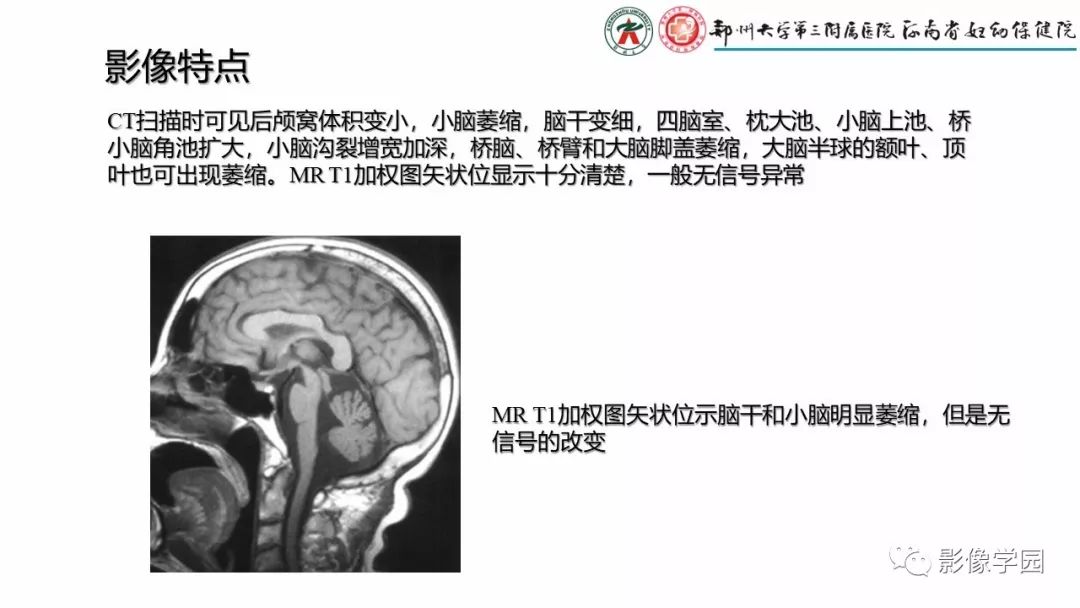 【PPT】脑干病变的影像学表现-31