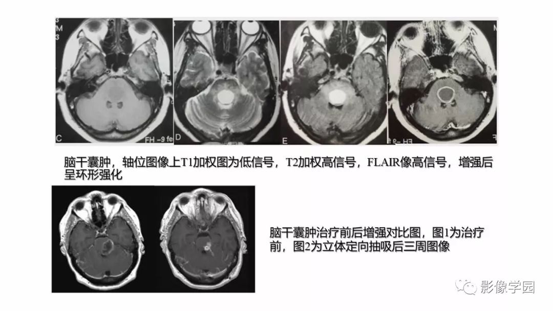 【PPT】脑干病变的影像学表现-20