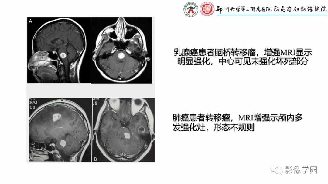 【PPT】脑干病变的影像学表现-12