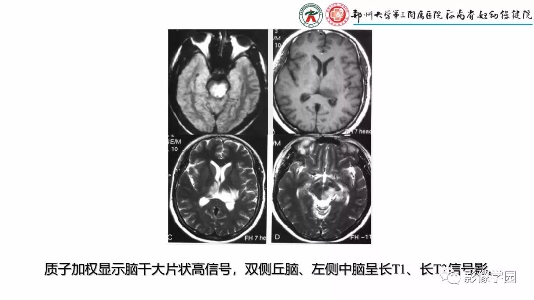 【PPT】脑干病变的影像学表现-24