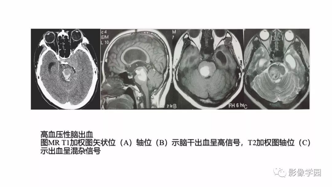 【PPT】脑干病变的影像学表现-18