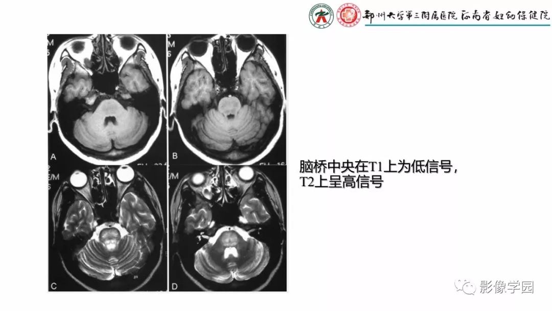 【PPT】脑干病变的影像学表现-27