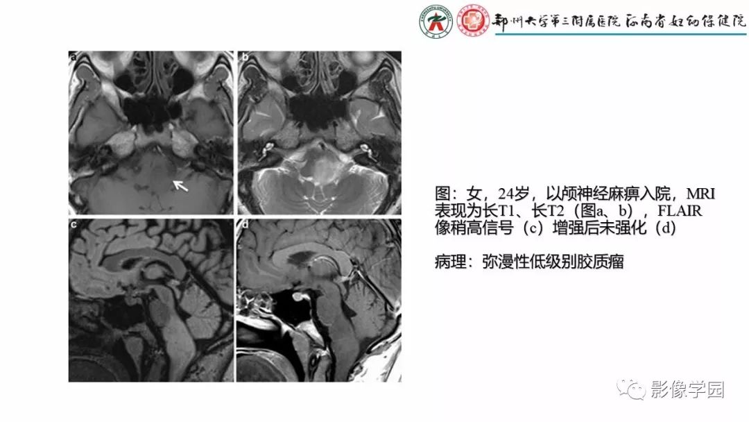 【PPT】脑干病变的影像学表现-6