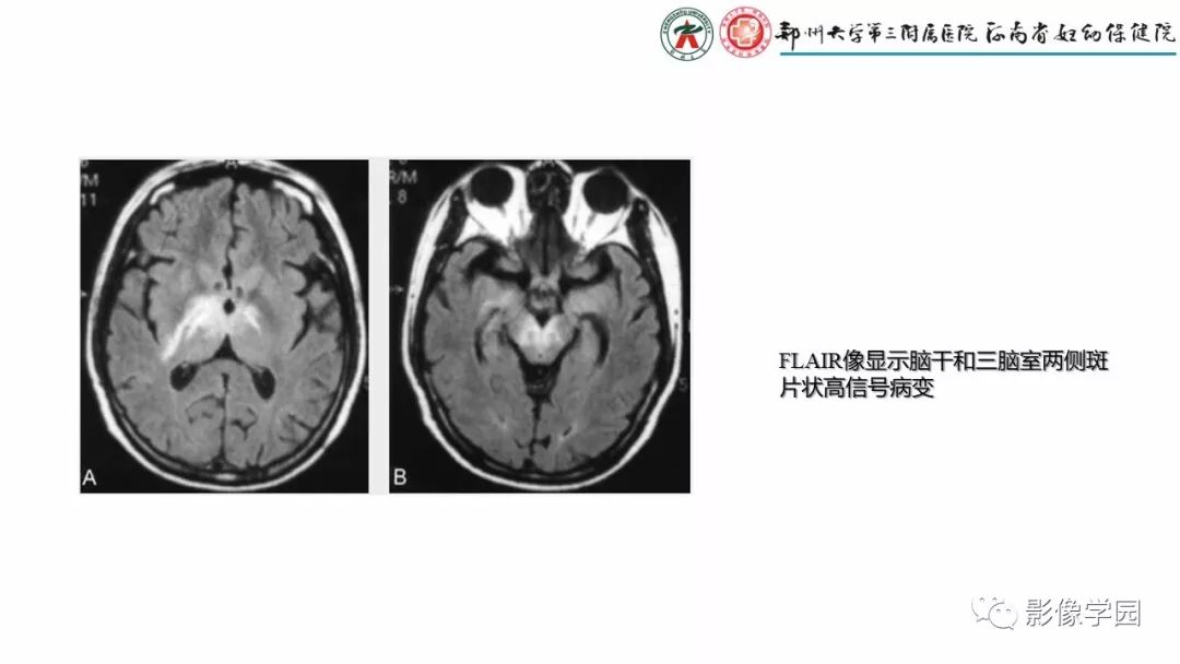 【PPT】脑干病变的影像学表现-38