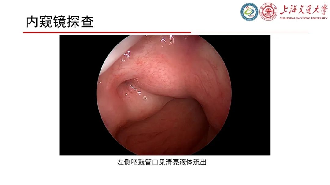 【病例】脑脊液耳漏1例CT及MR病例讨论-9