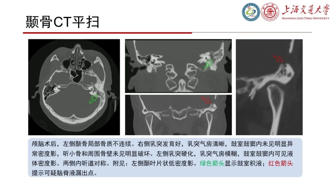 【病例】脑脊液耳漏1例CT及MR病例讨论-6