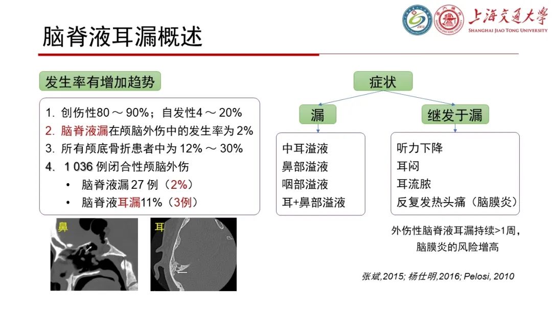 【病例】脑脊液耳漏1例CT及MR病例讨论-14