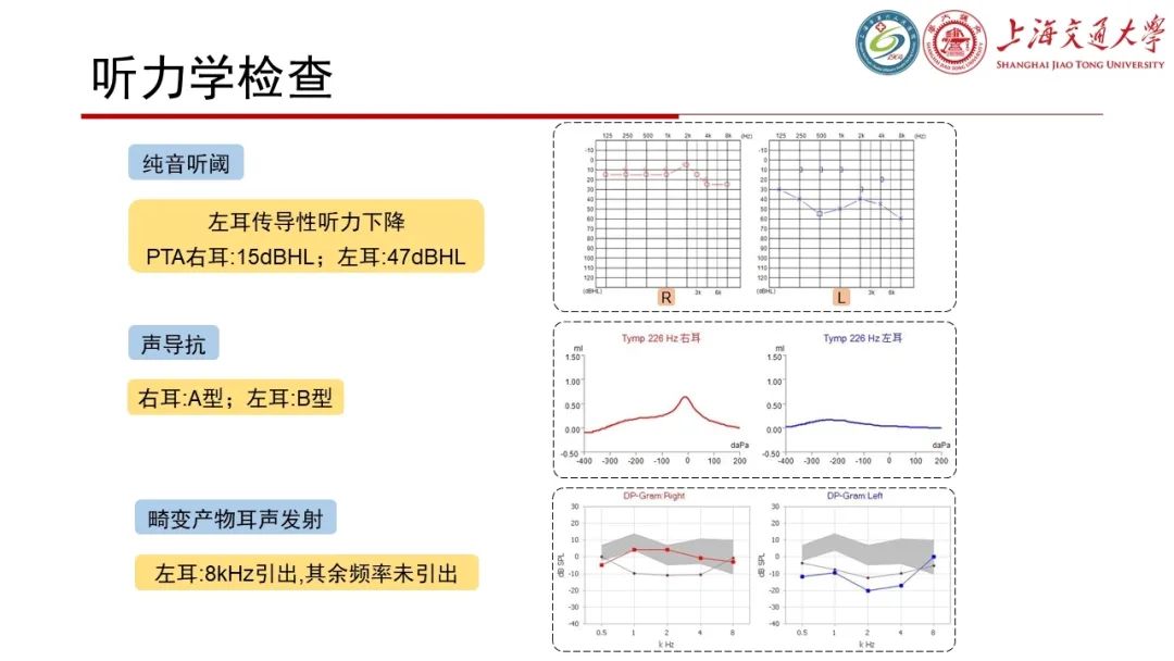 【病例】脑脊液耳漏1例CT及MR病例讨论-4