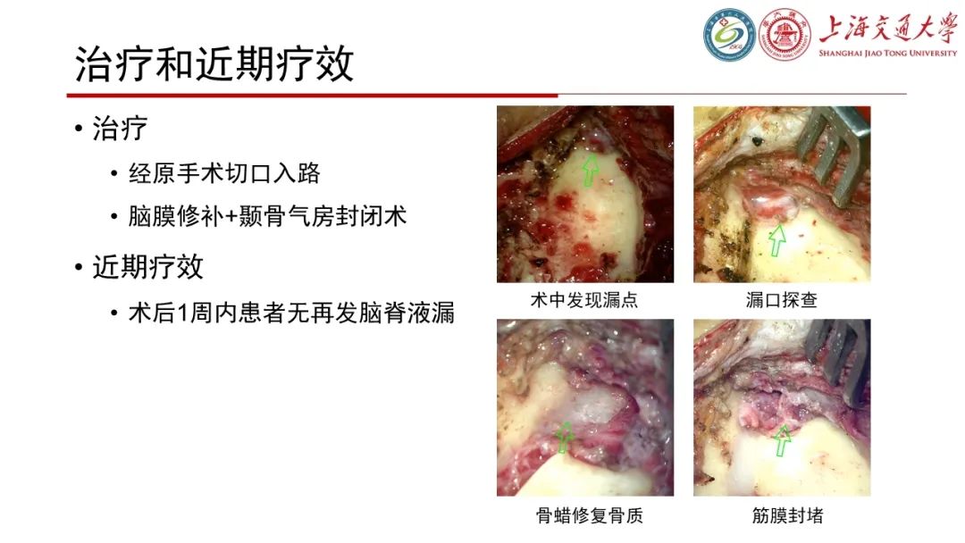 【病例】脑脊液耳漏1例CT及MR病例讨论-12